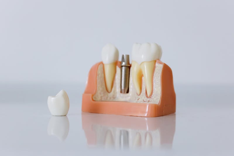 Close-up of a dental implant model showing jaw structure and titanium post
