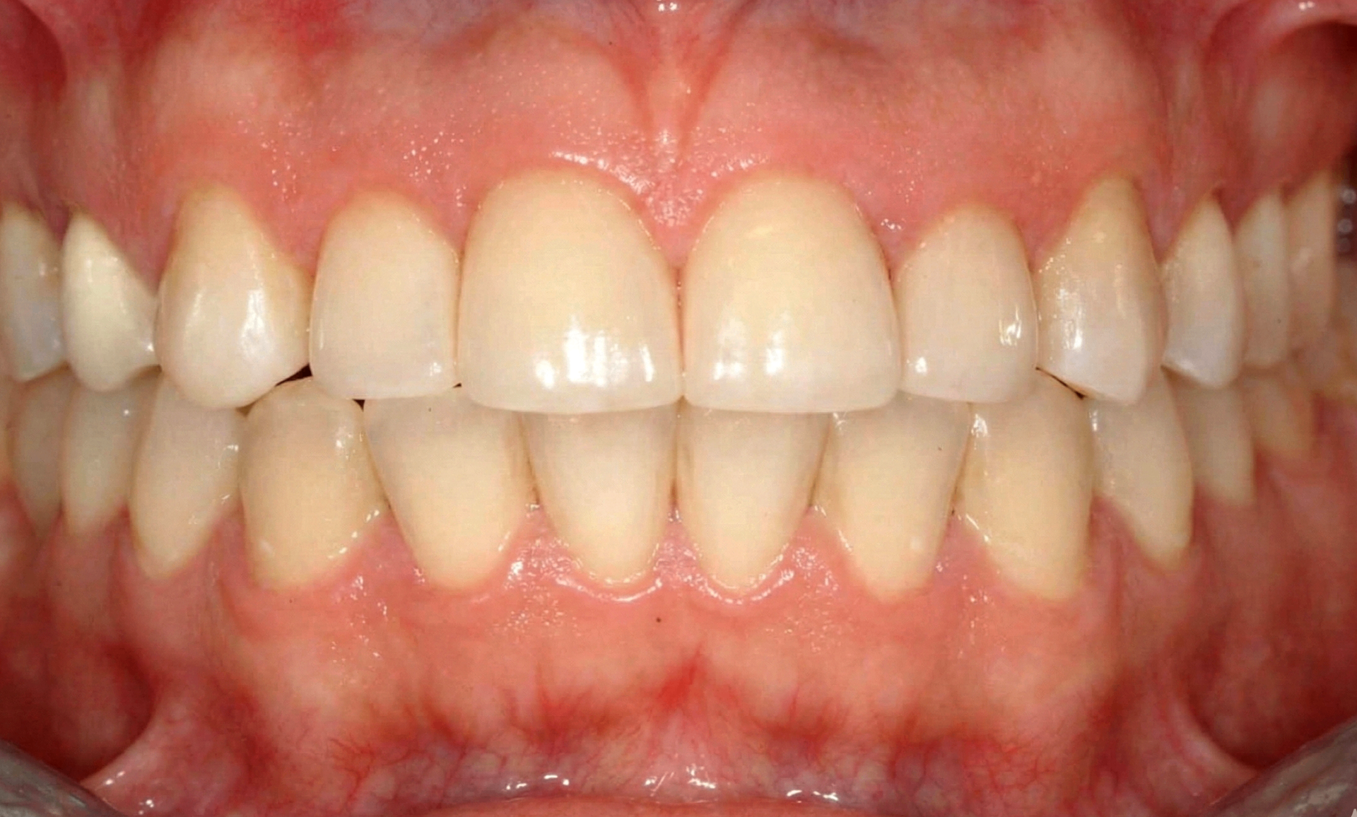 After treatment