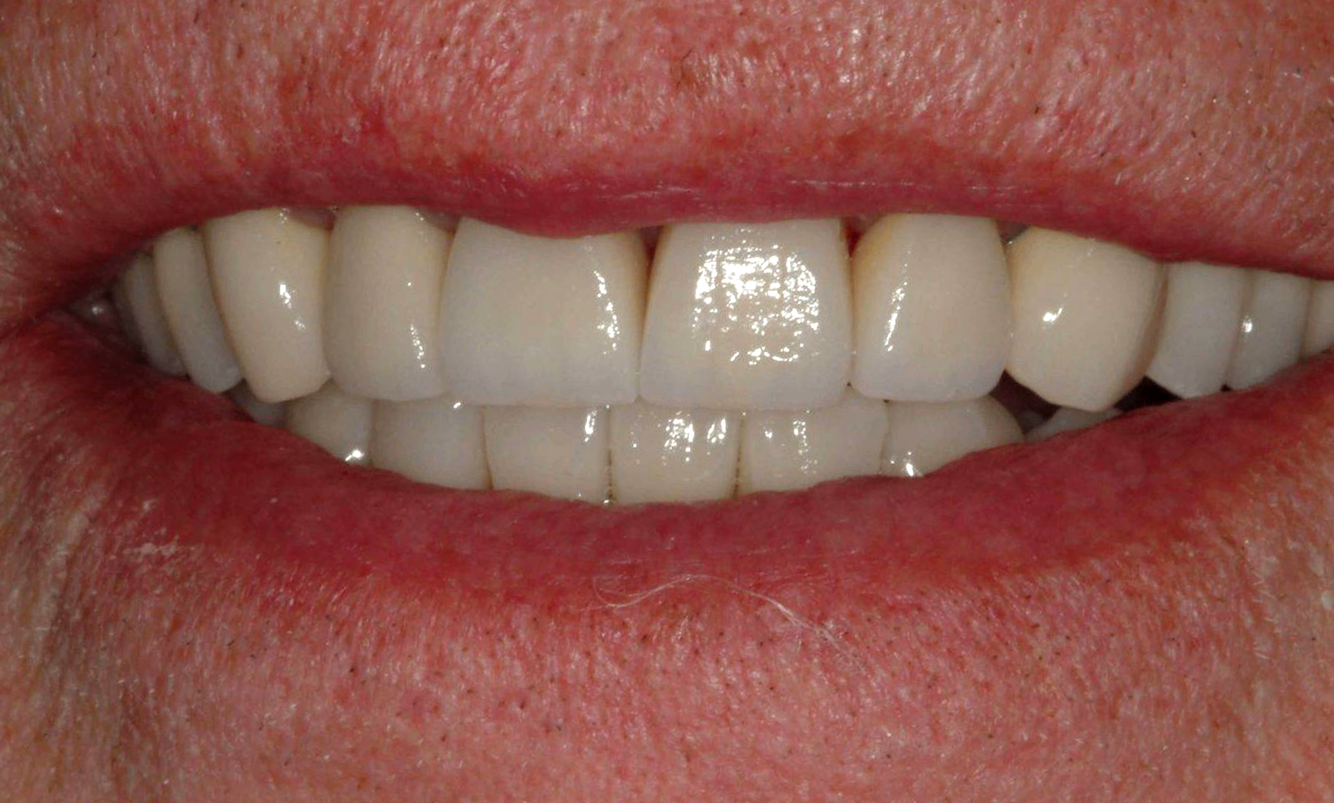 After treatment