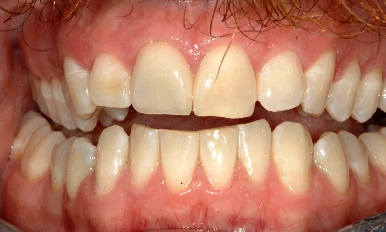After treatment