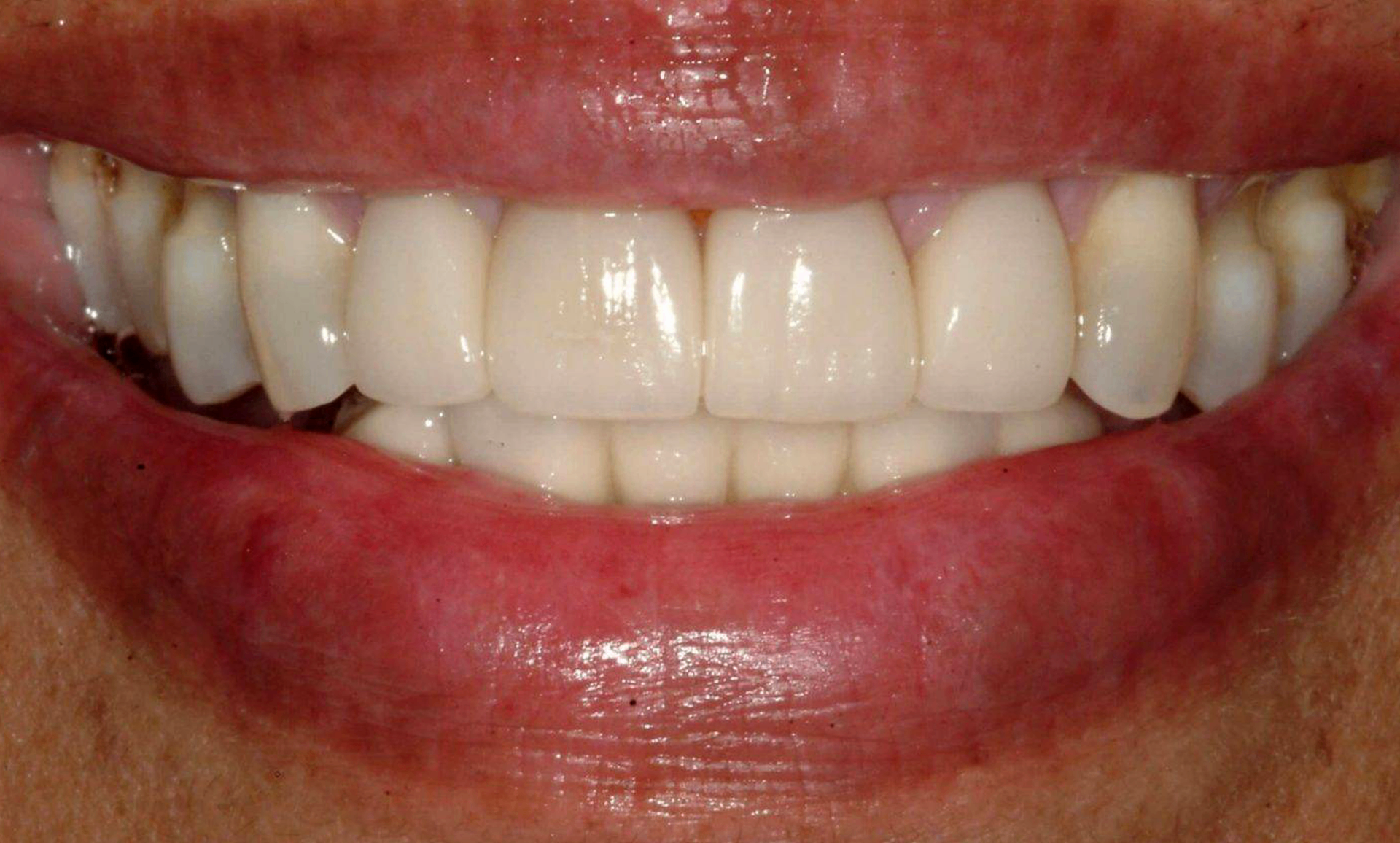 After treatment