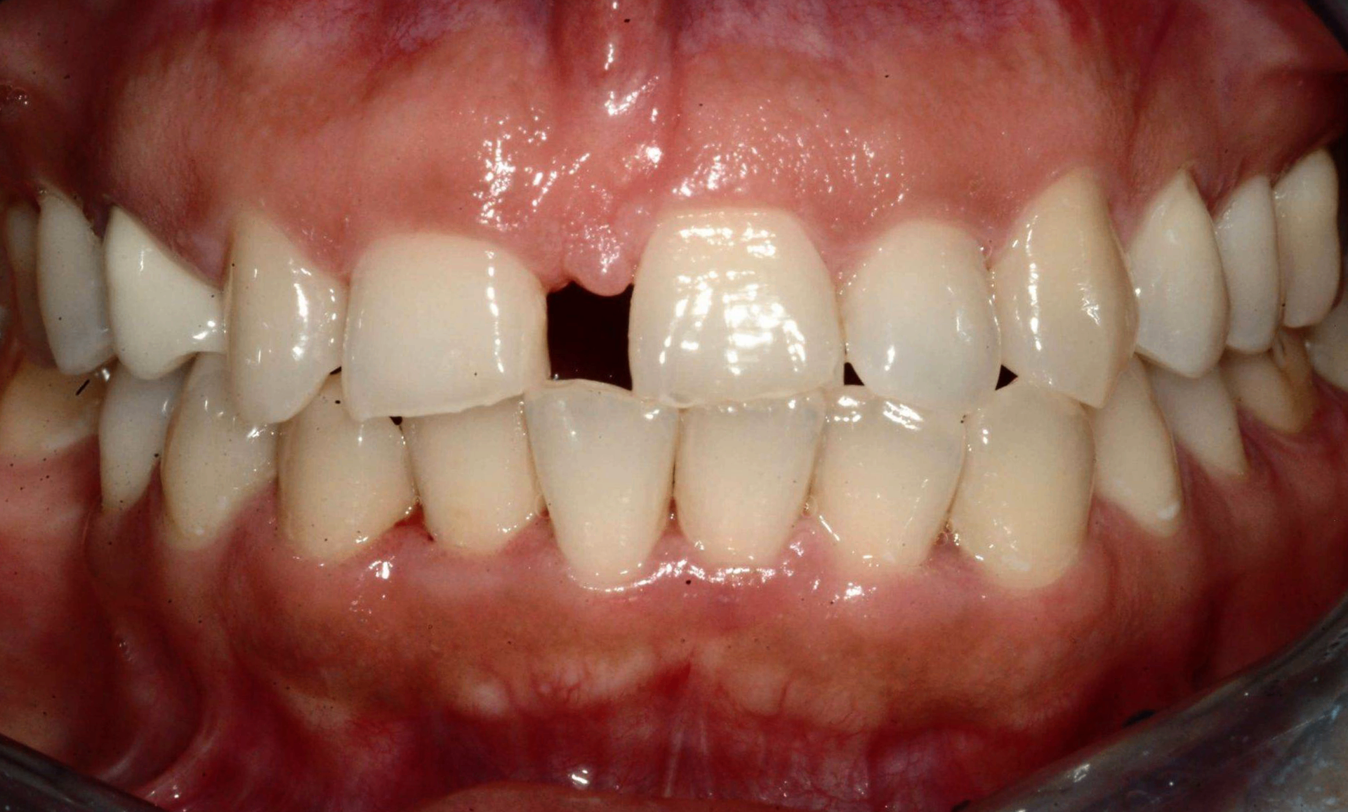 Before treatment